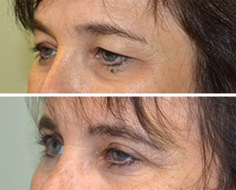 Upper Blepharoplasty by Dr. Baccaro