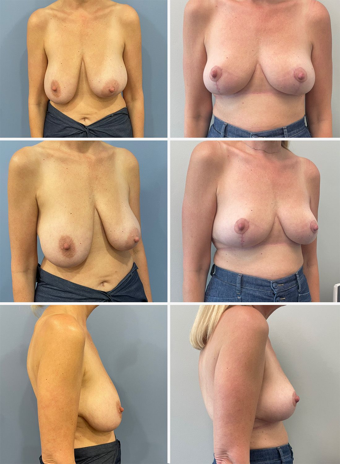 Breast Lift performed by Dr. Walsh