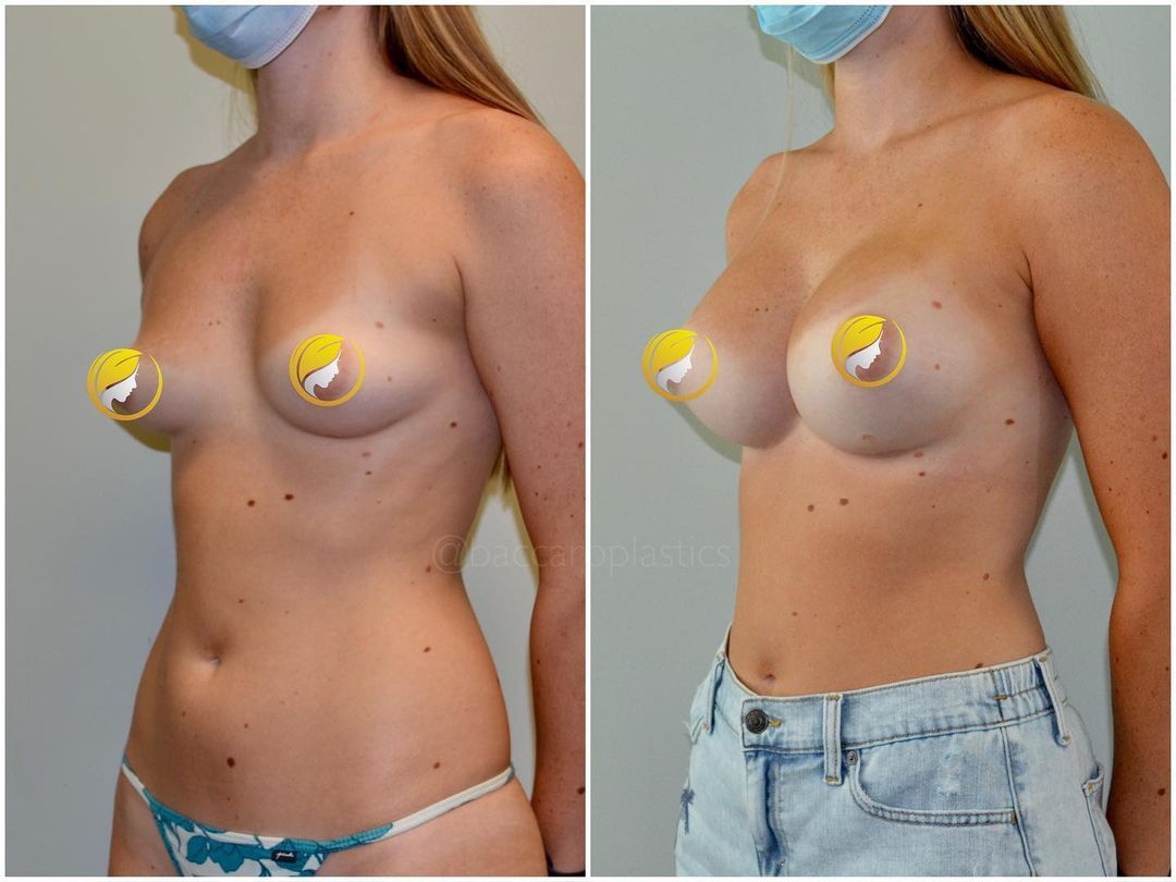 Hybrid Breast Augmentation by Dr. Baccaro