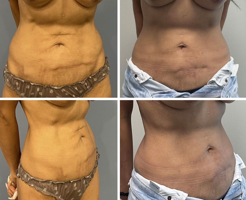 Reverse Tummy Tuck Performed by Dr. Bonett