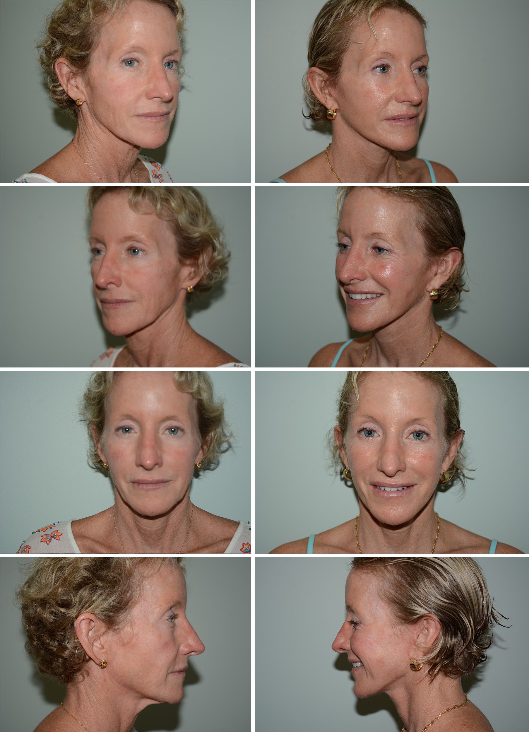 Mini Facelift by Dr. Gardner
