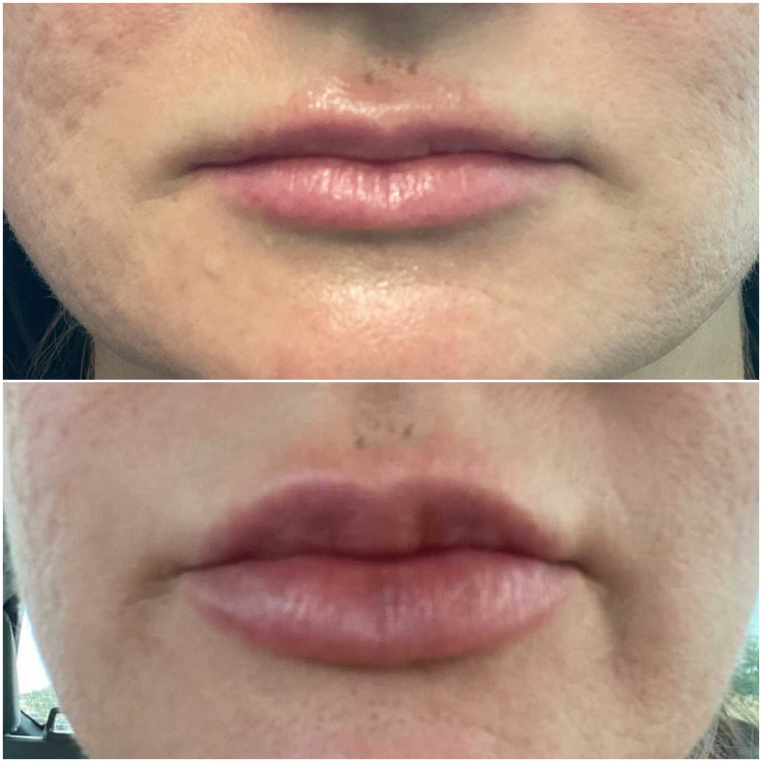 Lip Filler by Dr. Baccaro