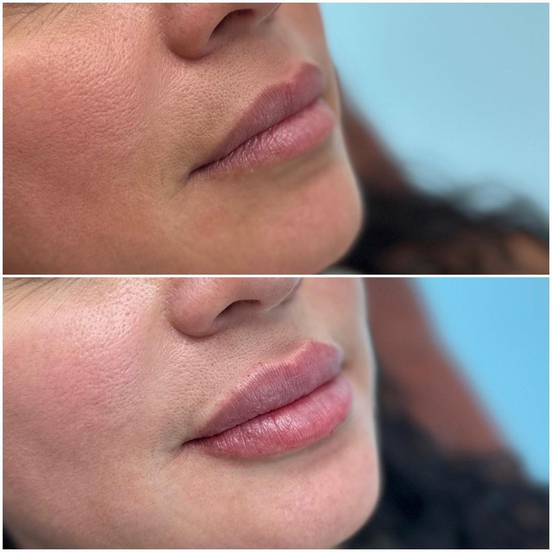 Lip Augmentation by Dr. Baccaro
