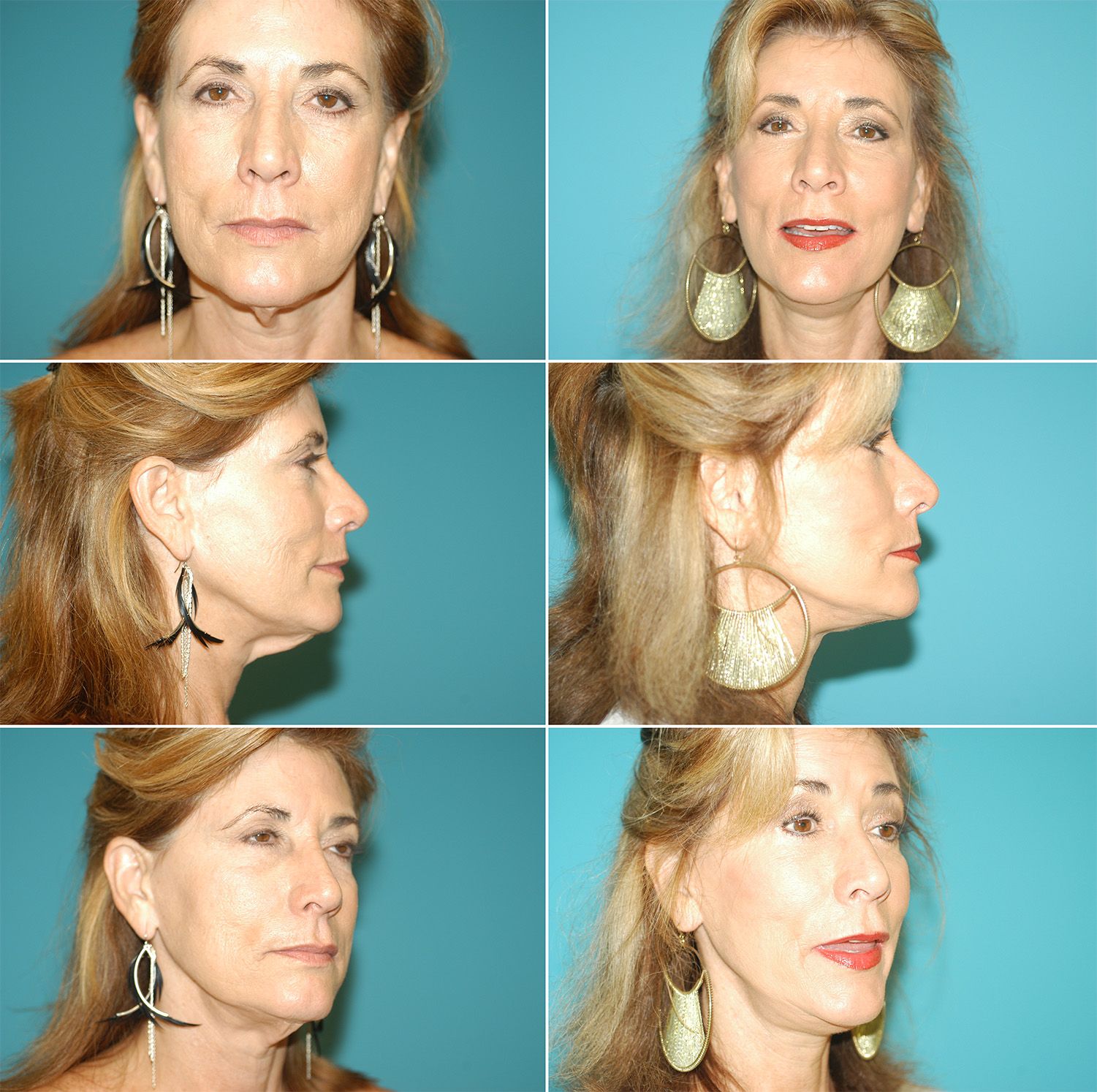 Facelift by Dr. Gardner