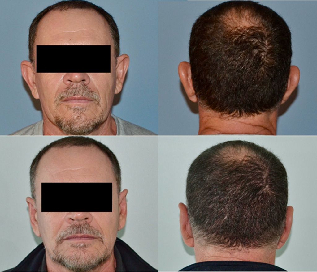 Otoplasty Performed by Dr. Baccaro