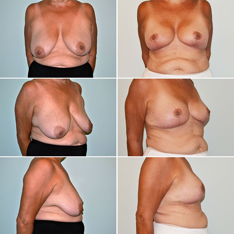 baccaro breast lift 1