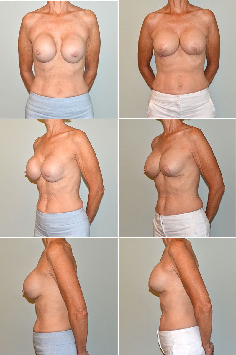 Breast Augmentation By Dr. Baccaro