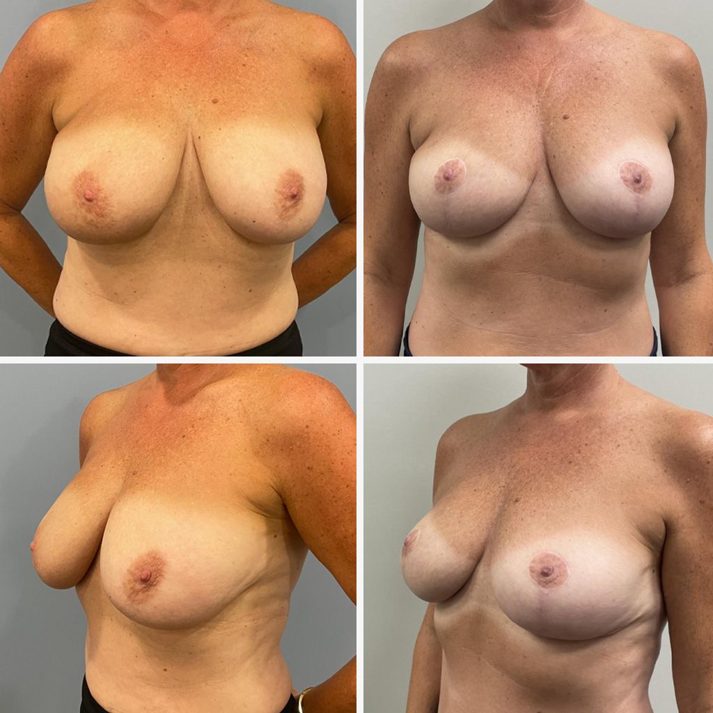 Breast Lift and Breast Reduction Performed by Dr. Bonett
