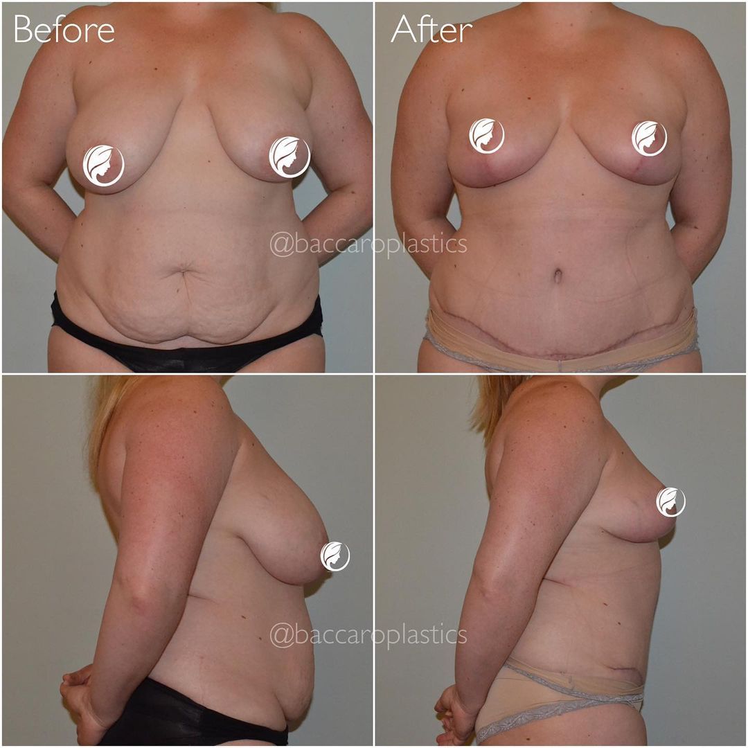Breast Reduction and Lift by Dr. Baccaro