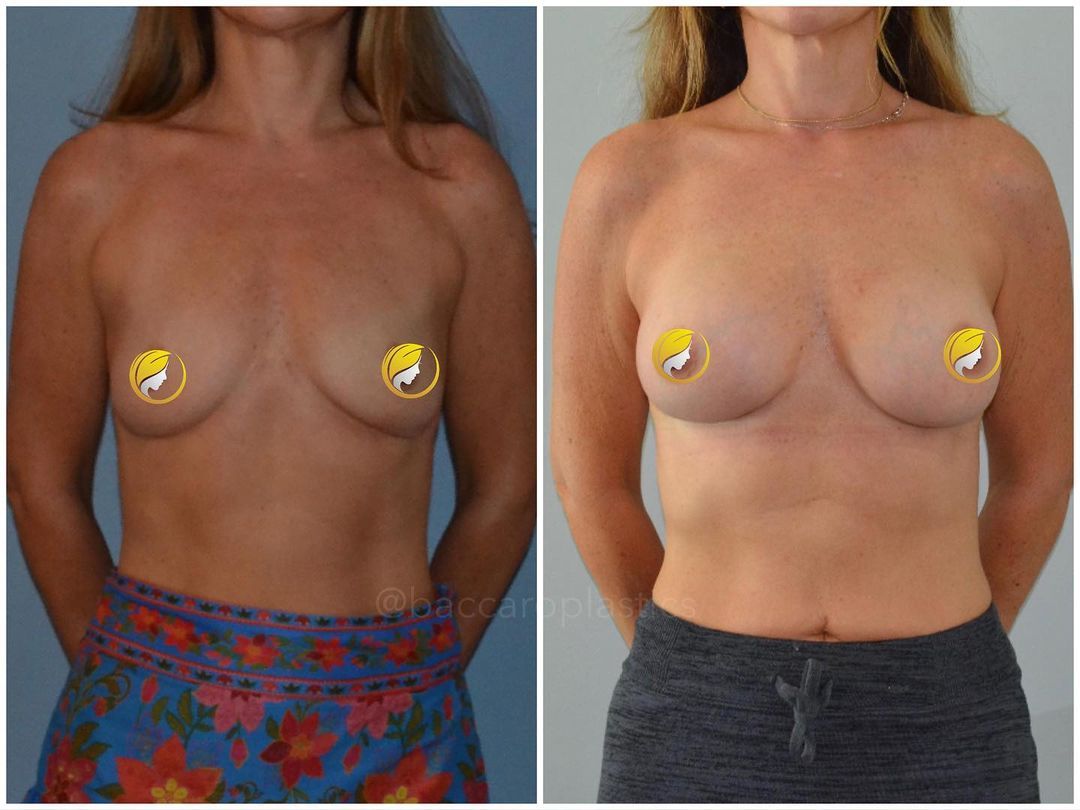 Hybrid Breast Augmentation by Dr. Baccaro