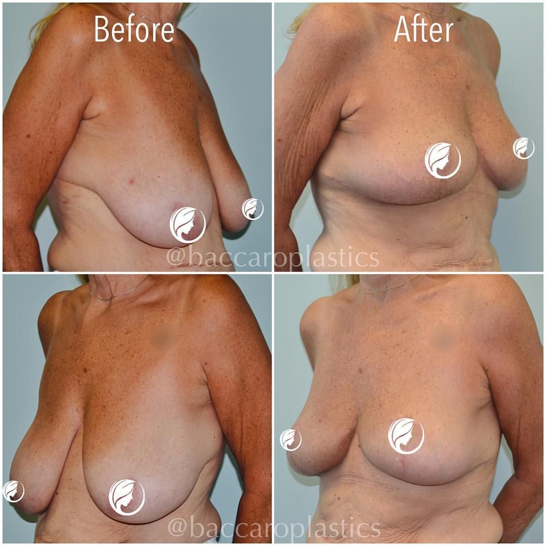Breast Reduction and Lift by Dr. Baccaro