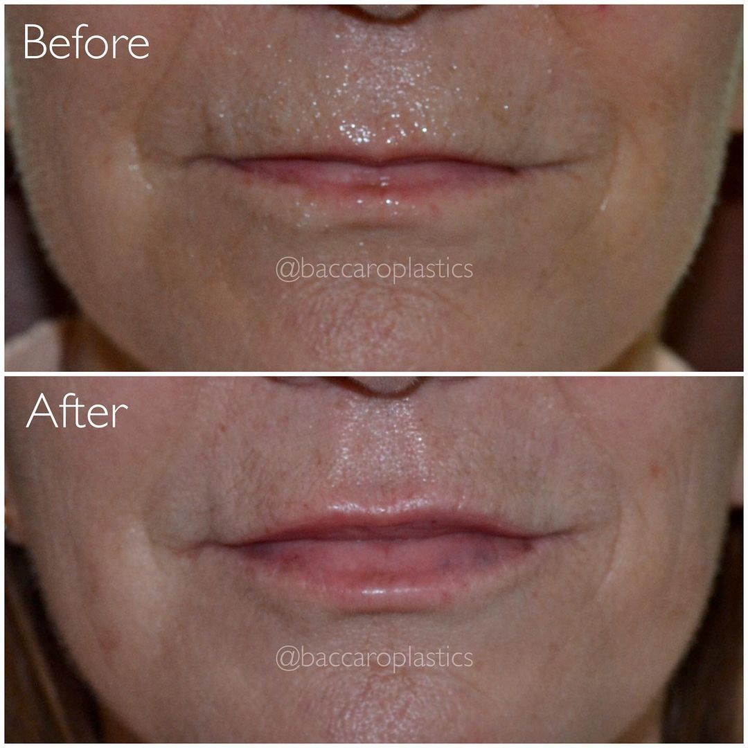 Lip Augmentation by Dr. Baccaro