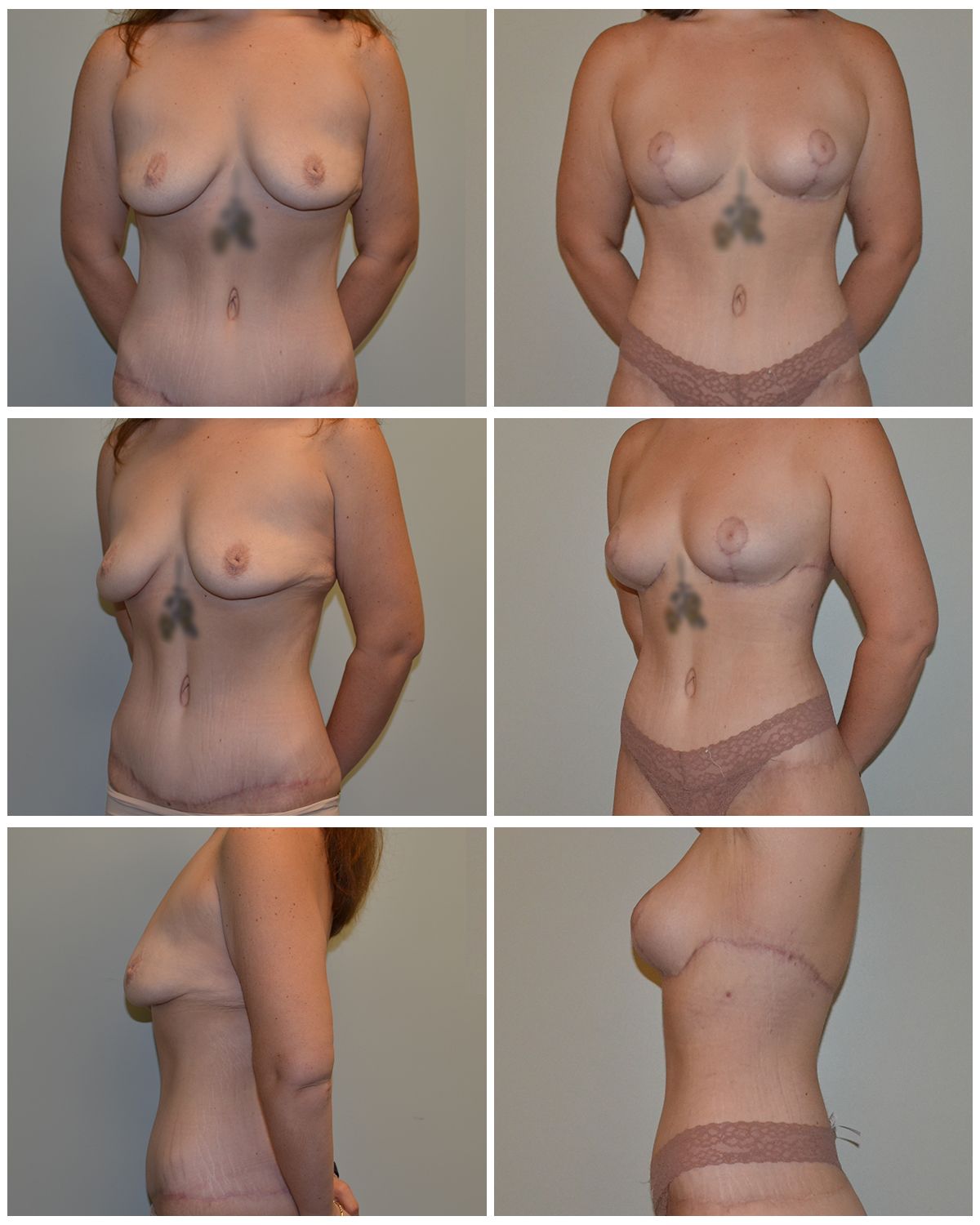 Breast Lift Performed by Dr. Baccaro