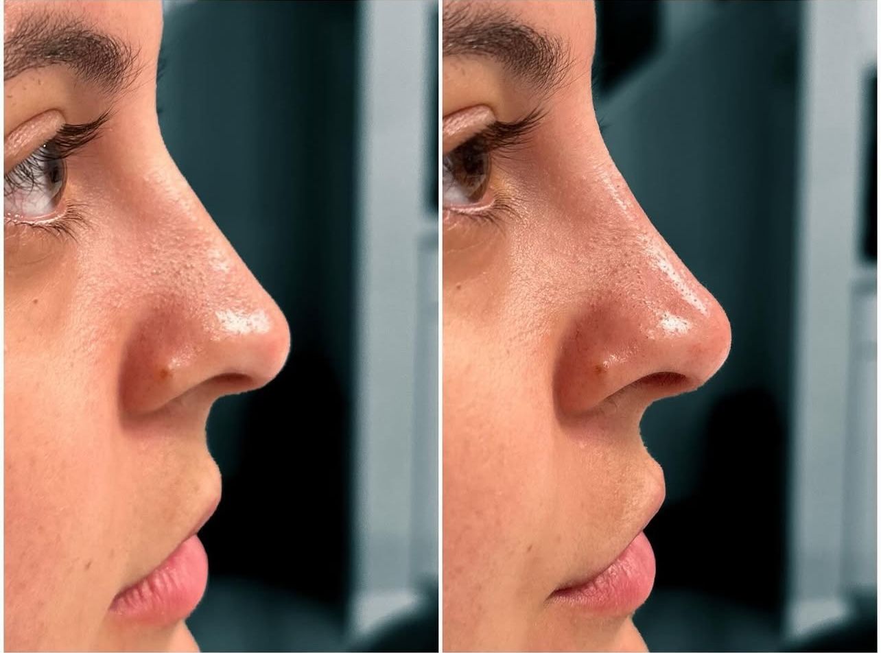 Liquid Rhinoplasty by Dr. Baccaro