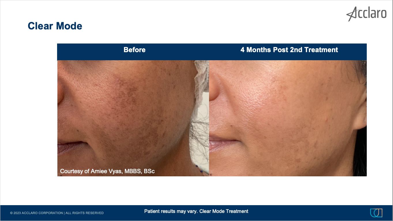 UltraClear Laser Performed by Amiee Vyas