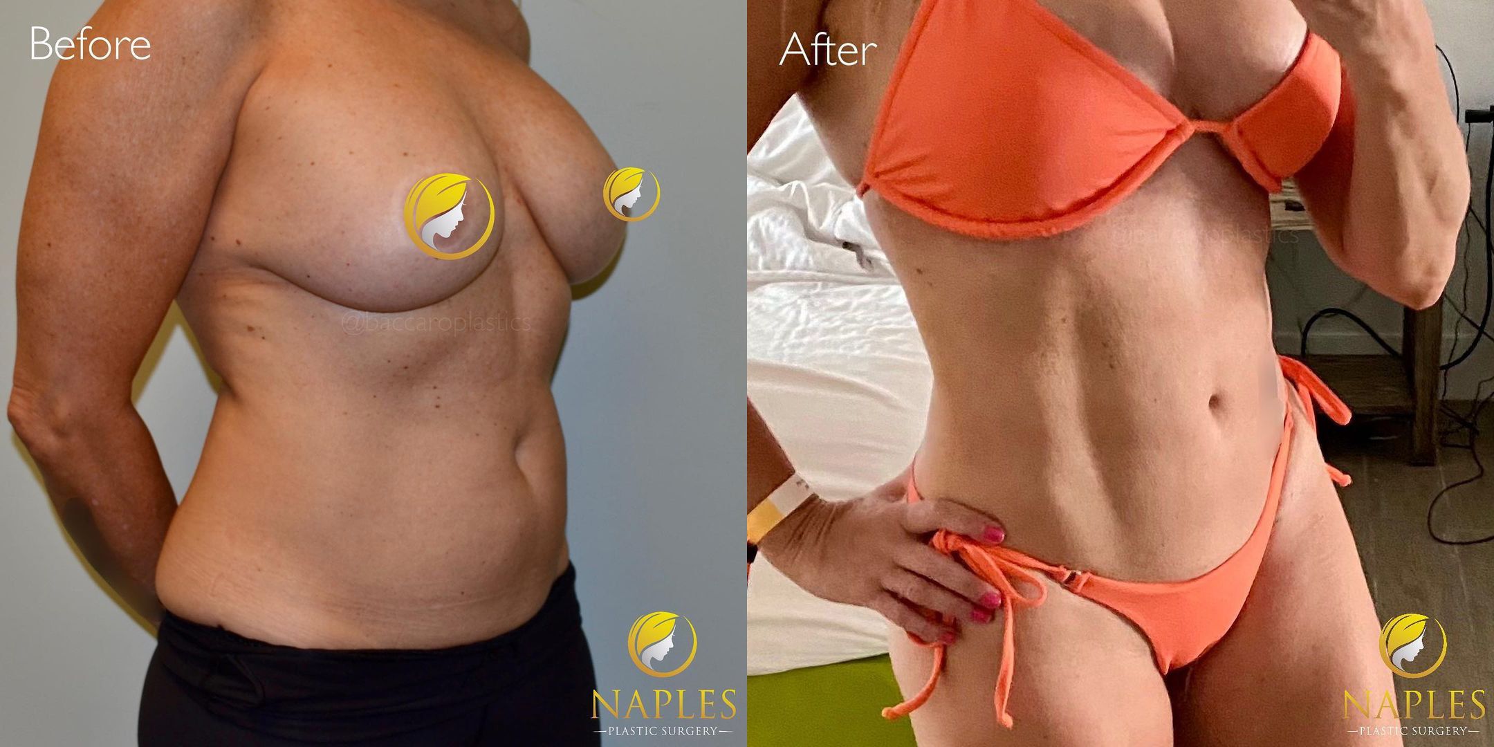 Hi-Def Lipo by Dr. Baccaro