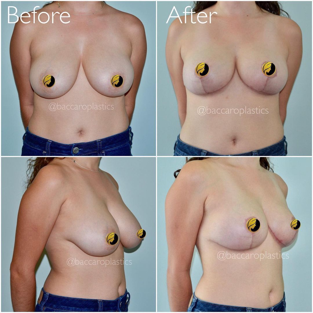 Breast Lift and Reduction by Dr. Baccaro