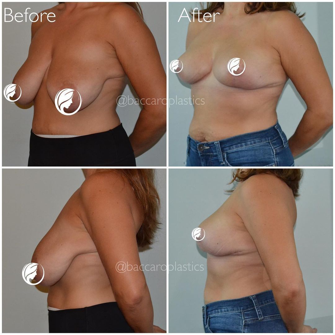 Breast Reduction and Lift by Dr. Baccaro