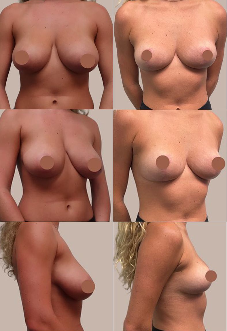 Surgery Performed by Dr. Mark Walsh