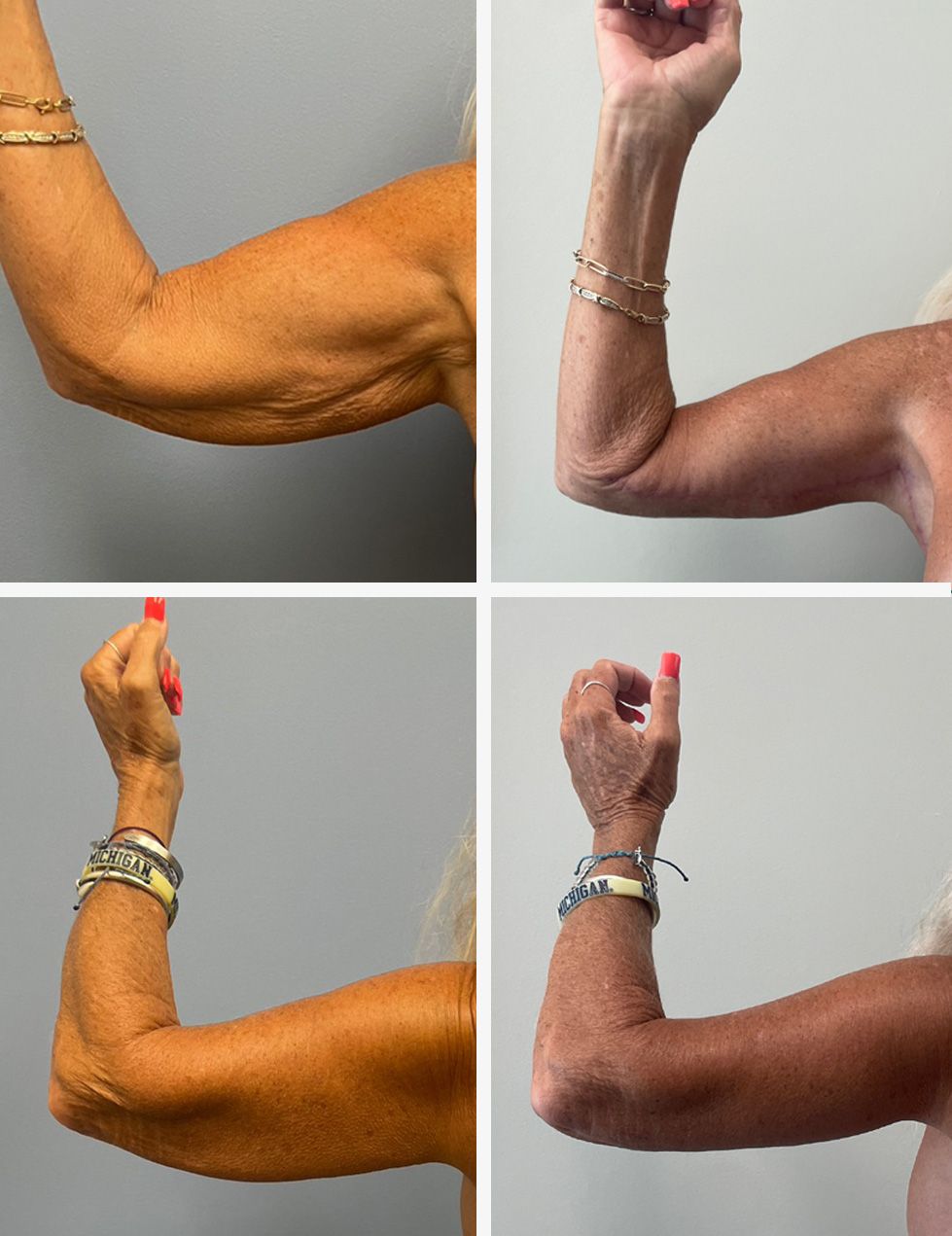 Arm Lift Performed by Dr. Walsh