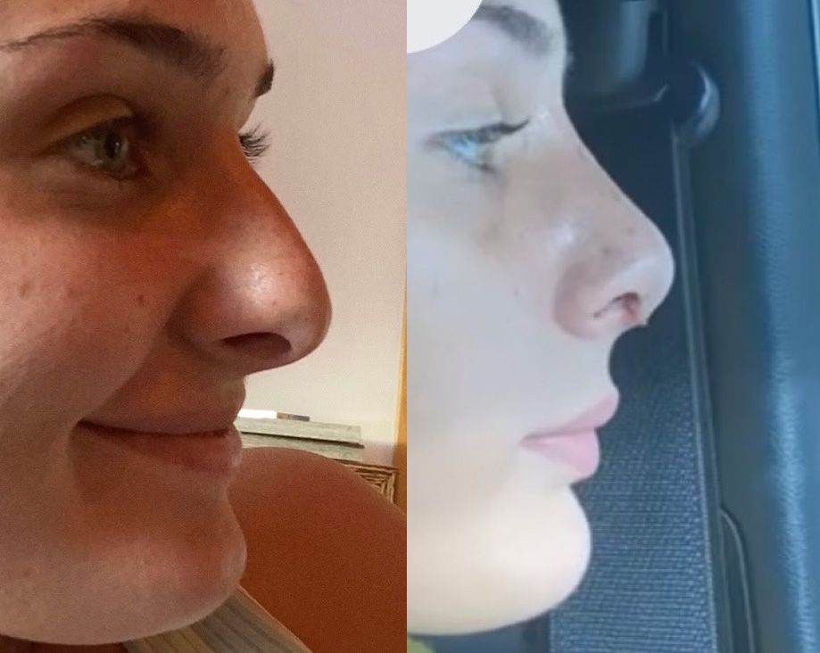 Rhinoplasty Performed by Dr. Baccaro