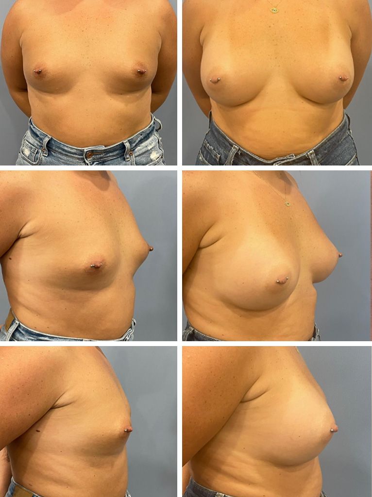 Breast Augmentation Performed by Dr. Bonett