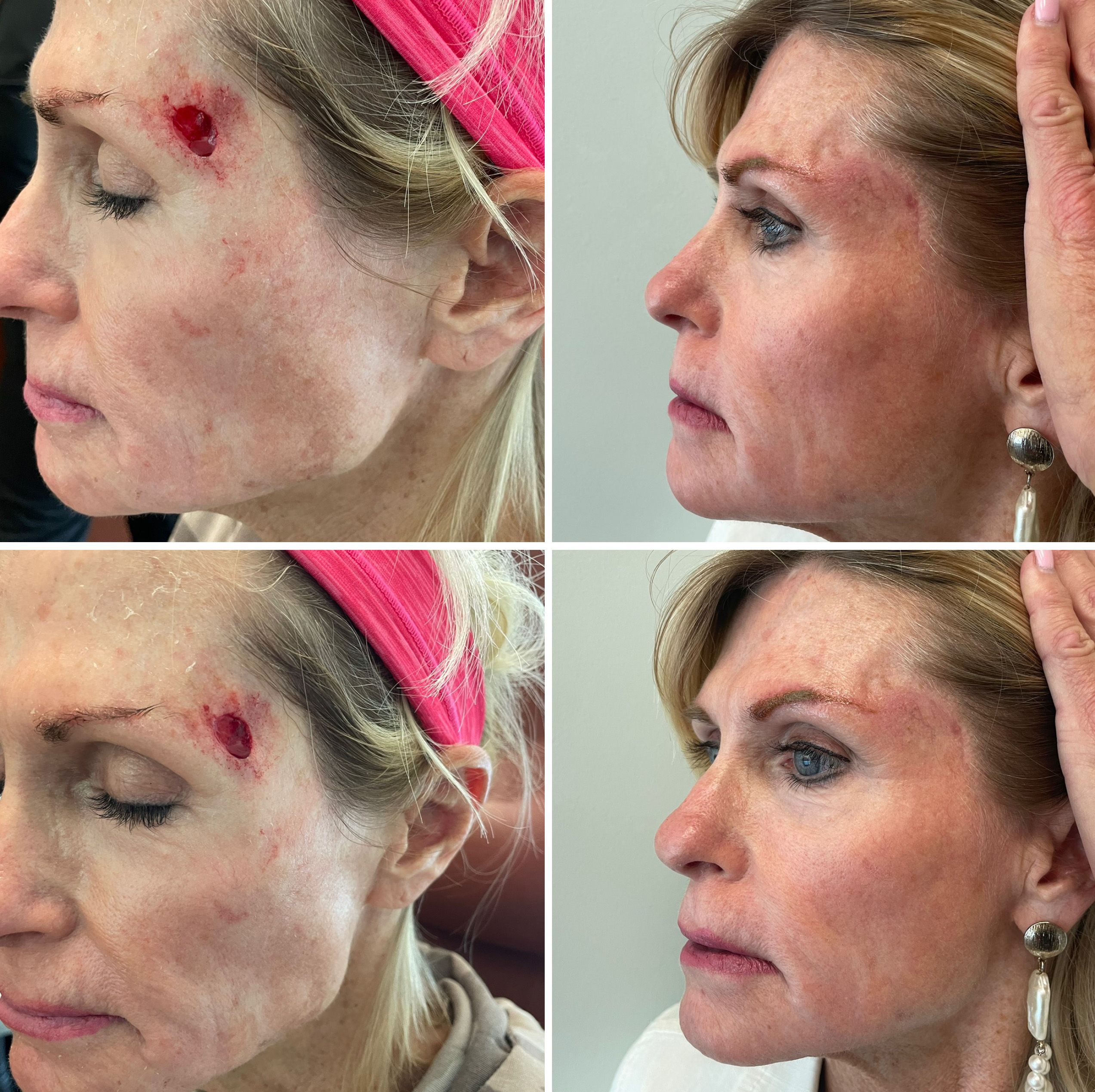 Mohs Reconstruction Surgery by Dr. Bonett 