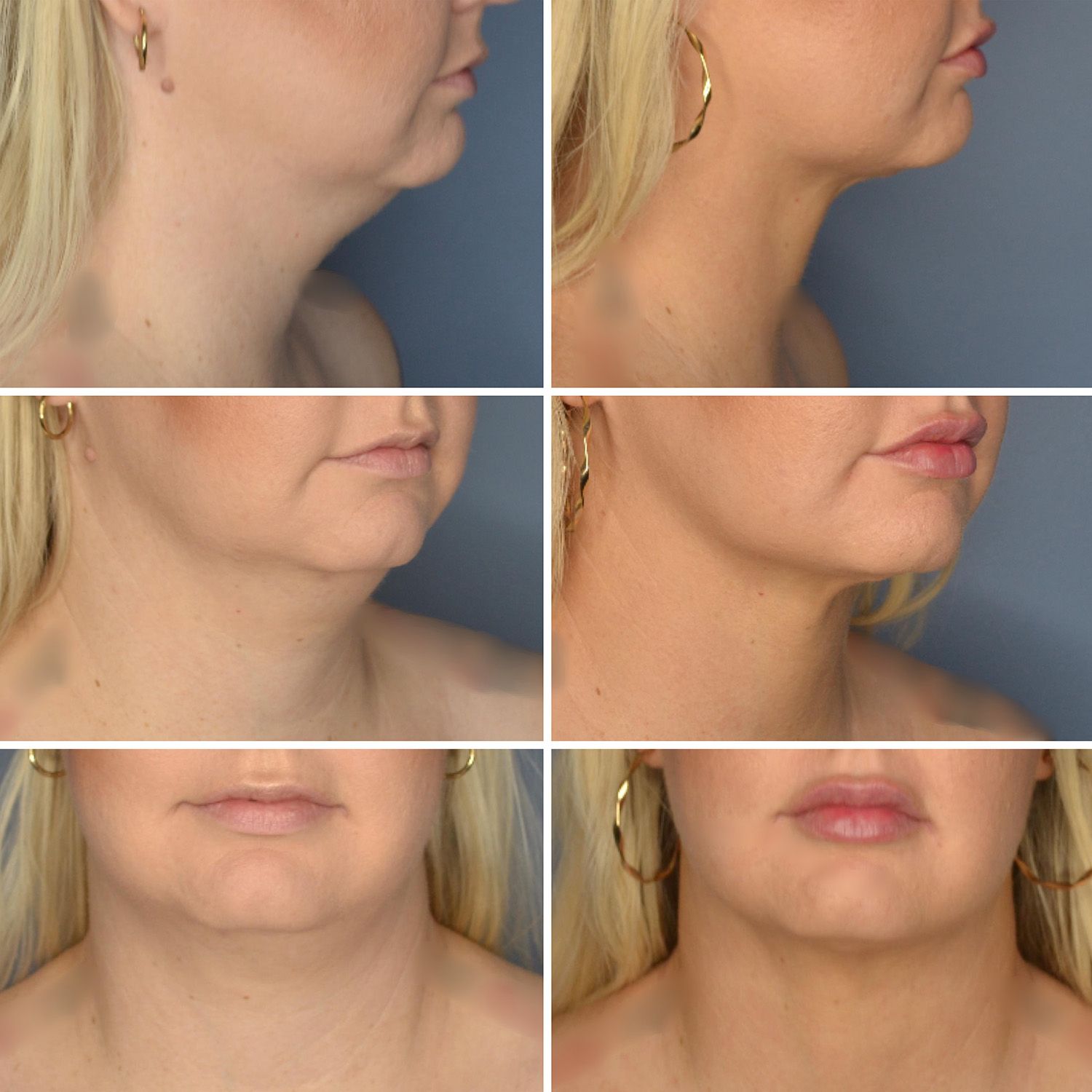 Neck Lipo with Skin Tightening by Dr. Baccaro