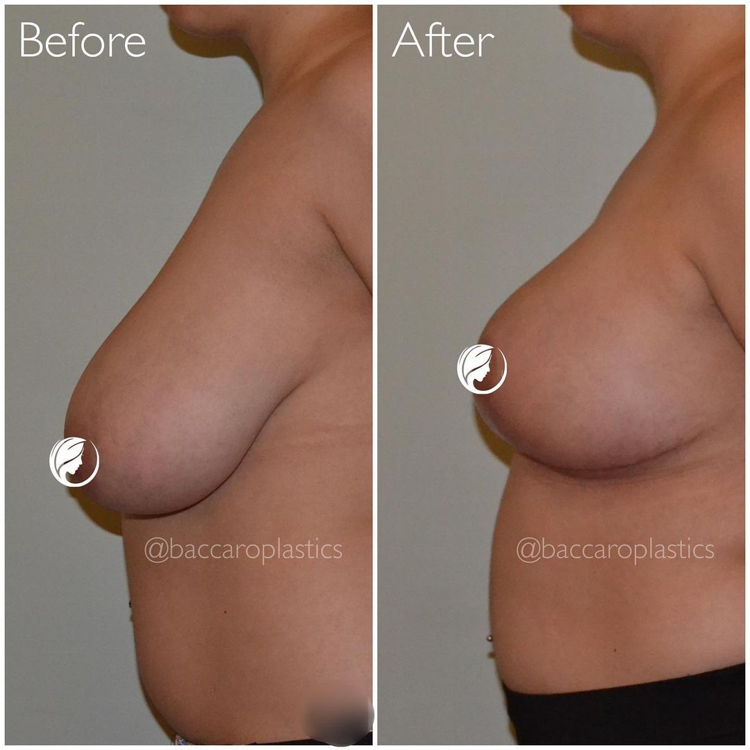 Breast Lift by Dr. Baccaro