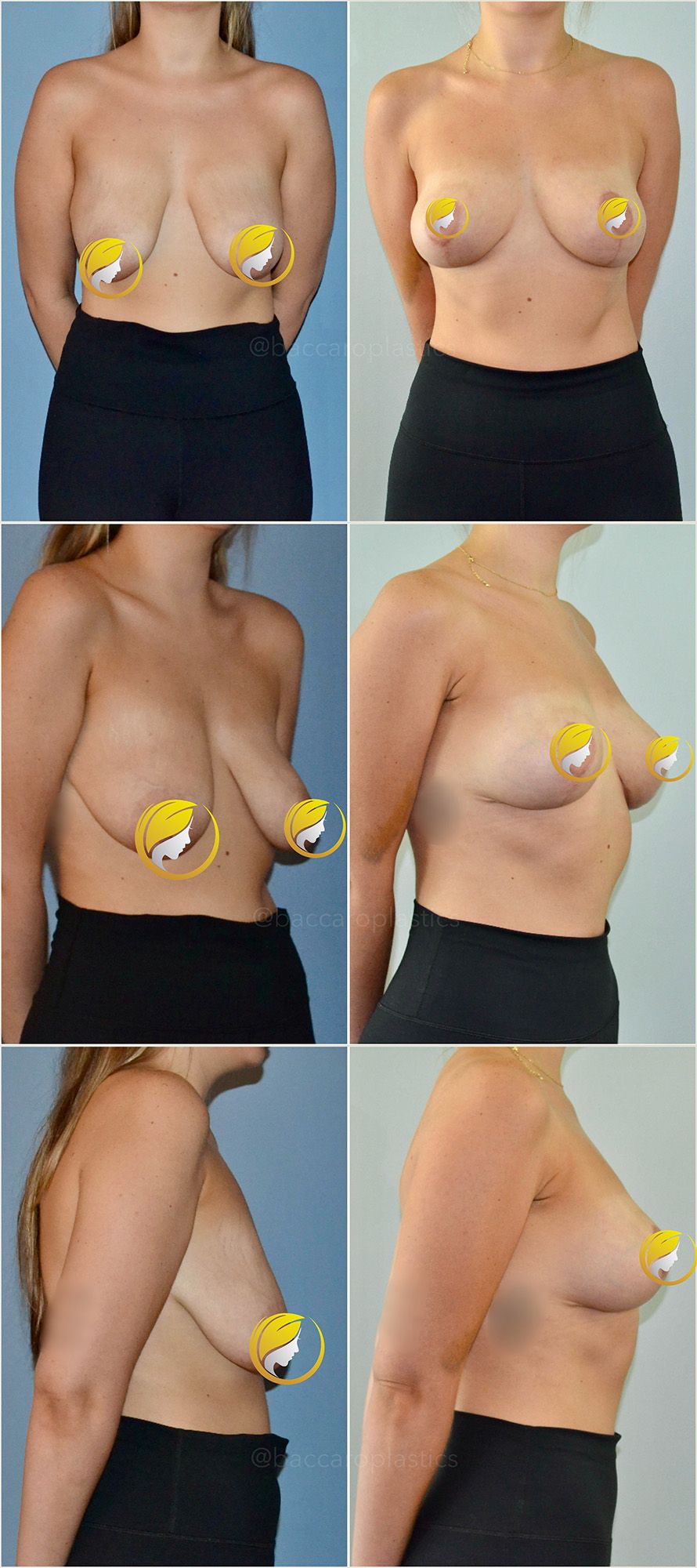Breast Lift Performed by Dr. Baccaro
