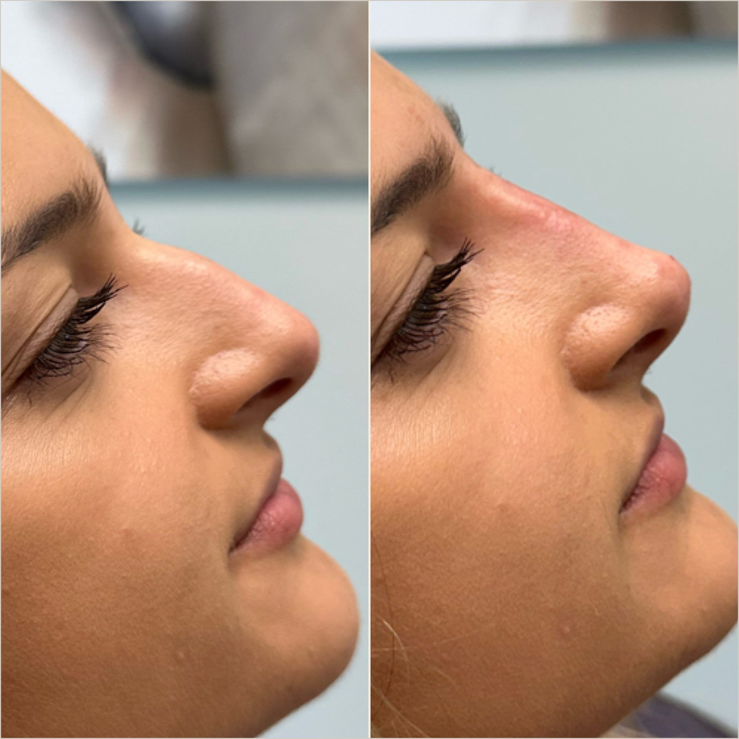 Liquid Rhinoplasty Performed by Dr. Baccaro