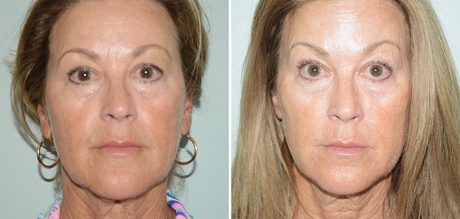 Fat Grafts to Face Performed by Dr. Gardner