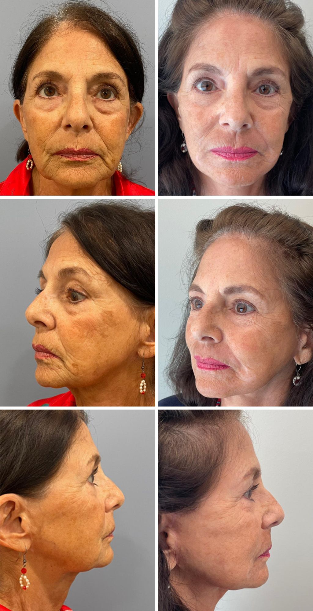 Mini Facelift performed by Dr. Bonett