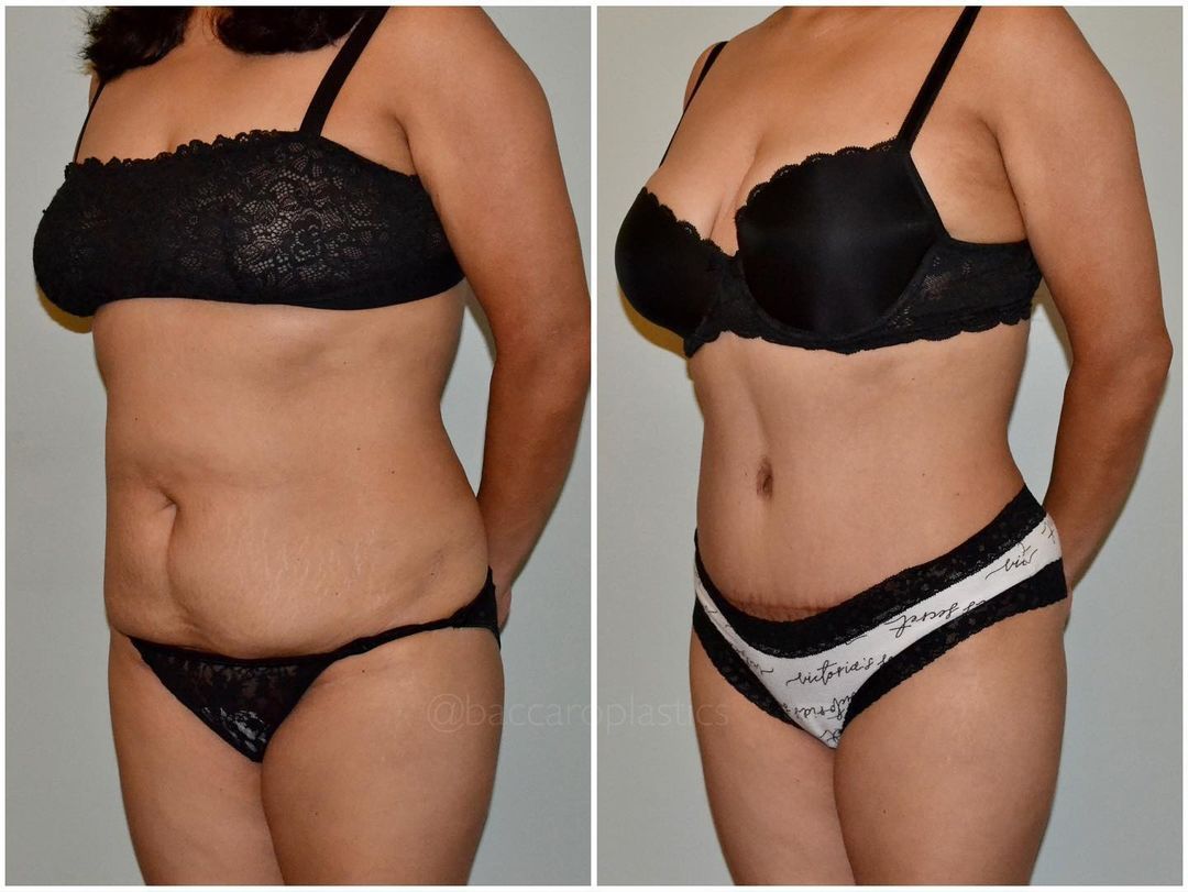Tummy Tuck + Lipo 360 by Dr. Baccaro