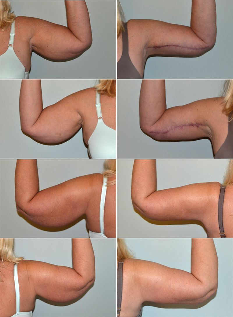 arm lift 02