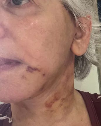 Neck Lift & Facial Fat Transfer Day 5