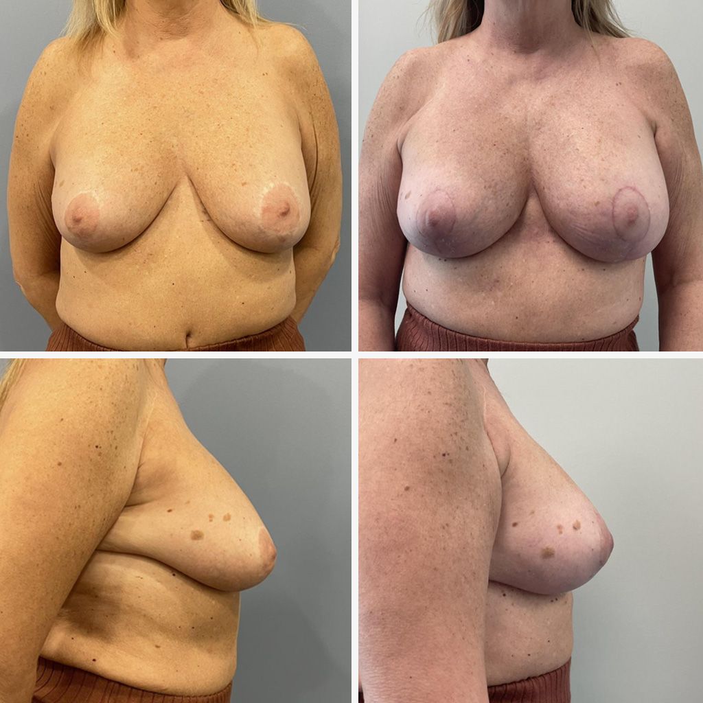 Breast Lift and Breast Reduction Performed by Dr. Bonett