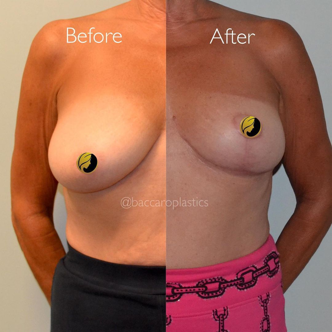 Breast Lift and Reduction by Dr. Baccaro