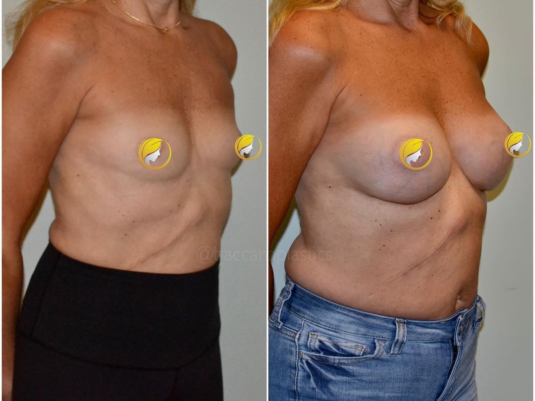 Hybrid Breast Augmentation by Dr. Baccaro
