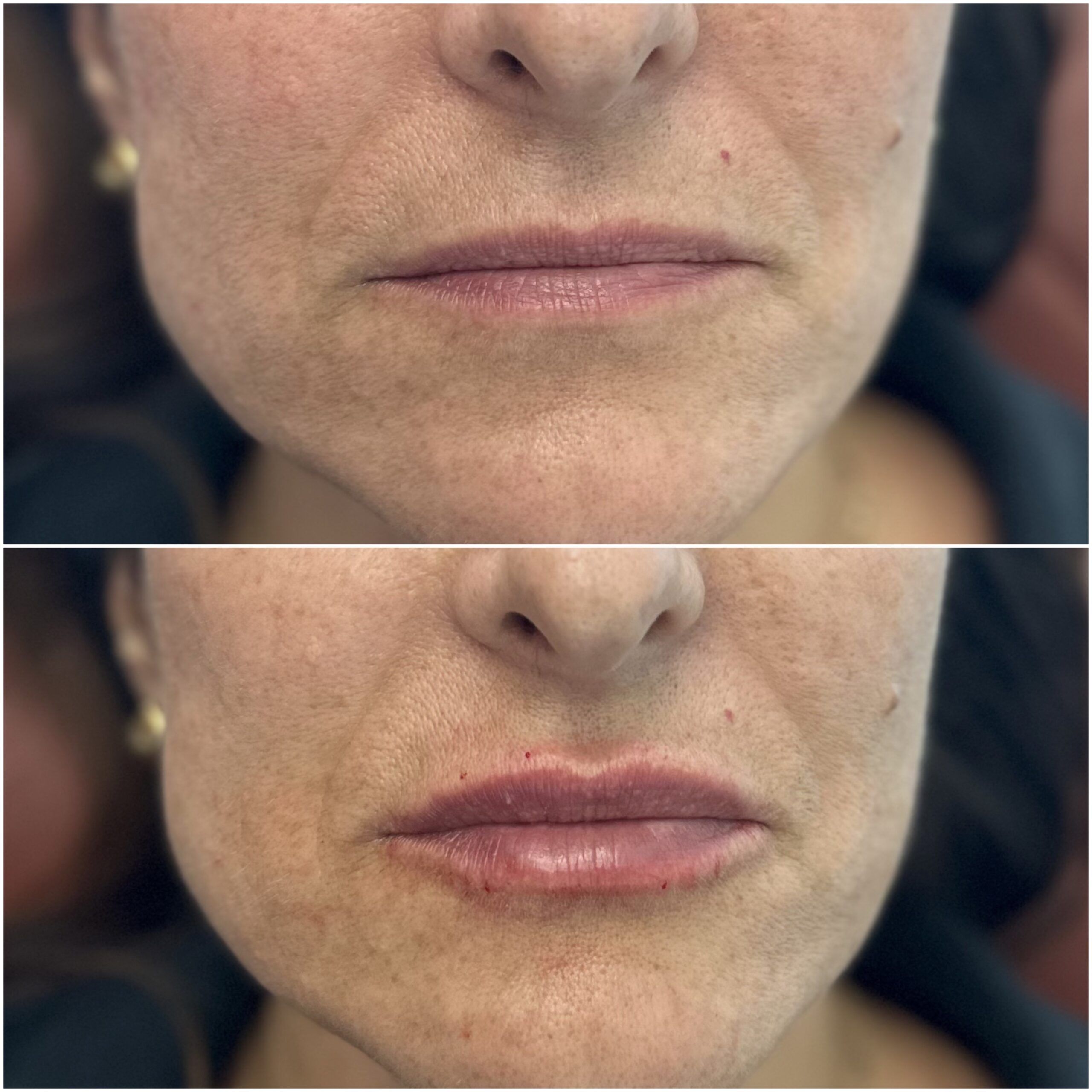 Lip Filler by Dr. Baccaro