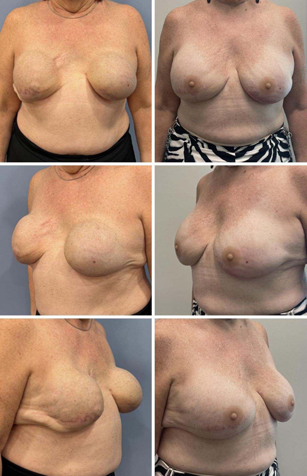 Breast Reconstruction performed by Dr. Bonett