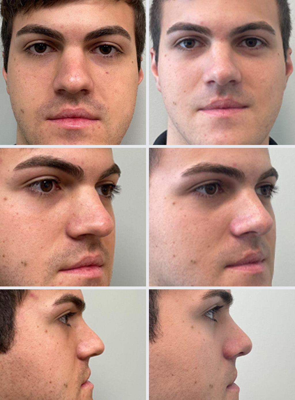 Rhinoplasty Performed by Dr. Bonett