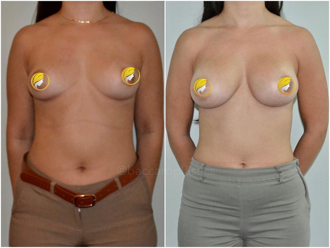 Hybrid Breast Augmentation by Dr. Baccaro