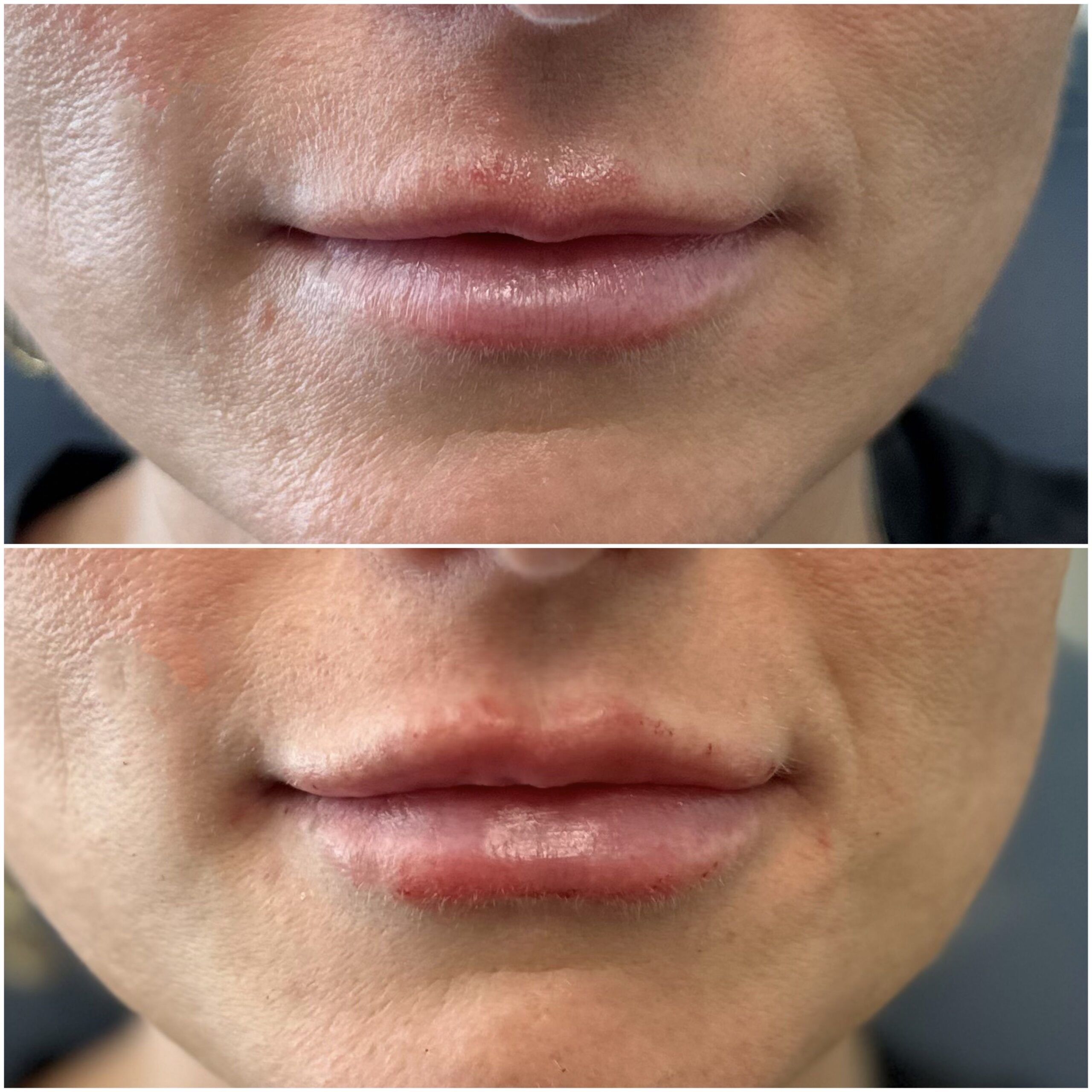 Lip Filler by Dr. Baccaro