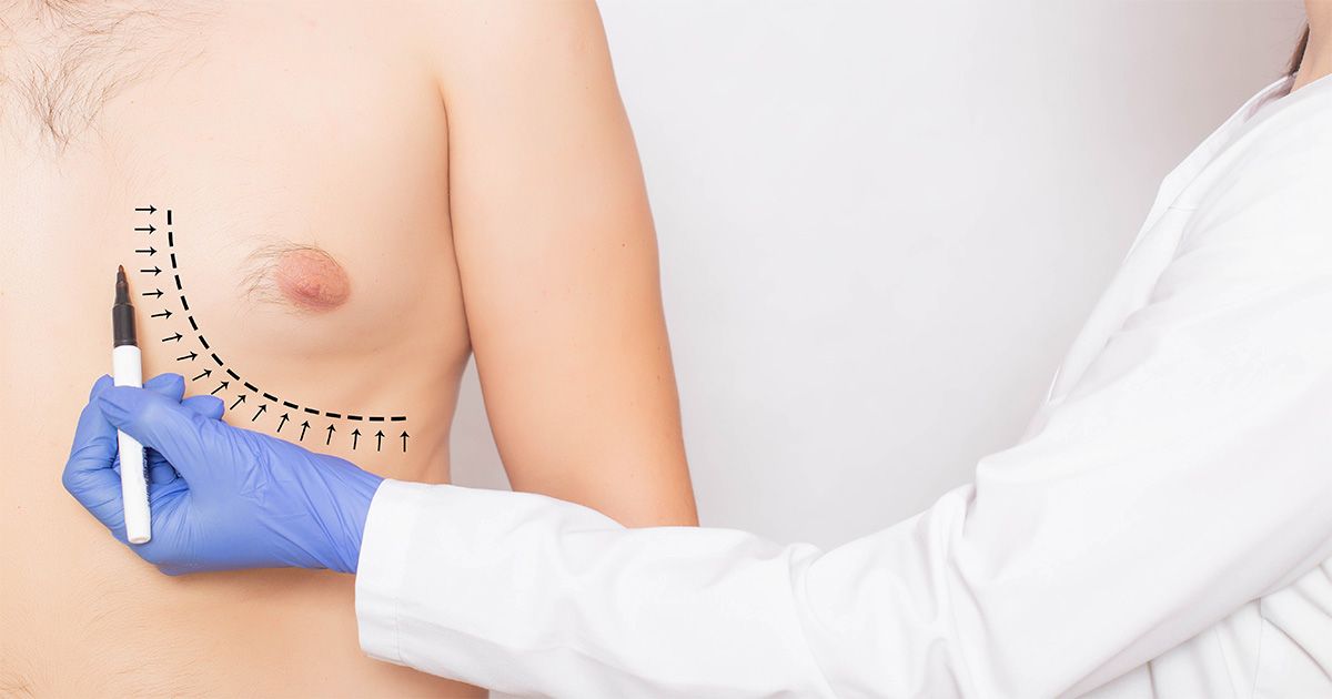gynecomastia procedures at naples plastic surgery