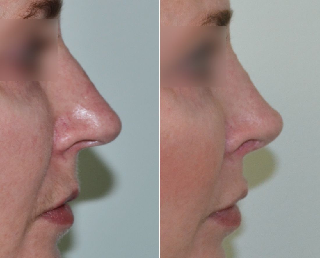 baccaro rhinoplasty 1