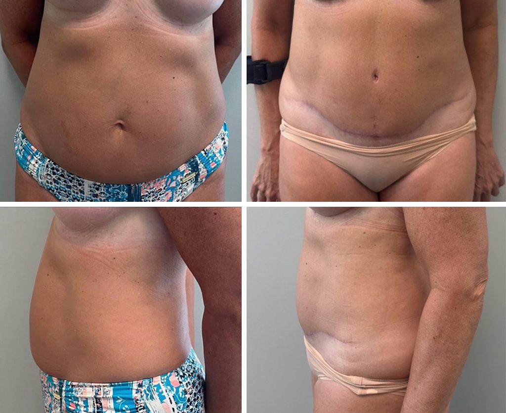 Tummy Tuck Performed by Dr. Bonett