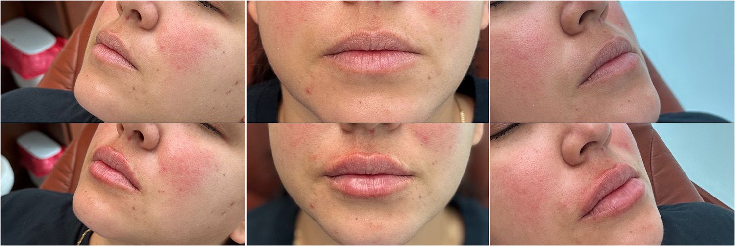 Lip Filler By Dr. Baccaro