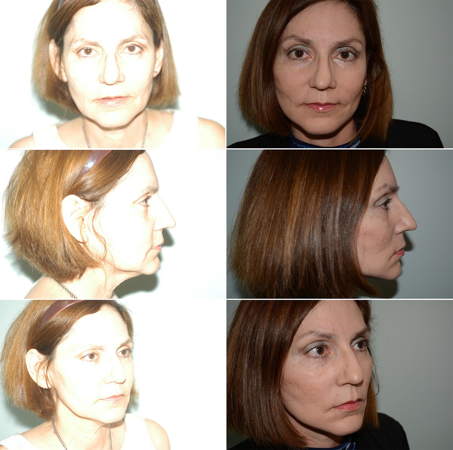 Brow and Face Lift by Dr. Gardner