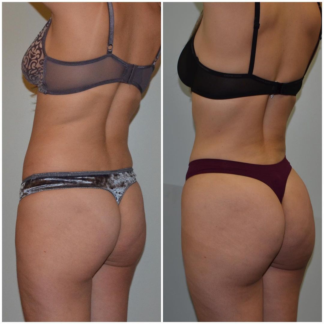 360 Lipo BBL by Dr. Baccaro